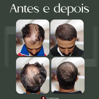 De uma calvície severa a uma cobertura densa e natural em toda a linha frontal e coroa.
ㅤ
Este caso 