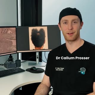 𝐀𝐅𝐑𝐎 𝐇𝐀𝐈𝐑 𝐓𝐑𝐀𝐍𝐒𝐏𝐋𝐀𝐍𝐓 CASES

Afro hair transplants require a different level of und