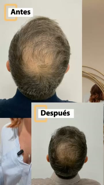 Caída del cabello, fortalecimiento, más brillo, densidad…la #MESOTERAPIACAPILAR es tu solución. 
Tu 