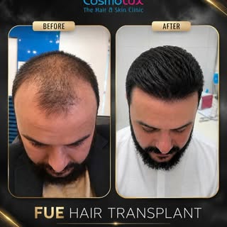FUE HAIR TRANSPLANT — REAL PEOPLE. REAL RESULTS. ✨

A fuller, more defined hairline can make a power