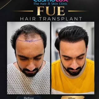 A New Hairline. A New Confidence. ✨

Take a look at this Before & After FUE Hair Transplant transfor
