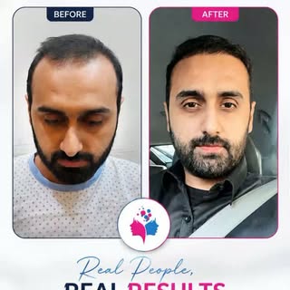 Real People. Real Results. Real Confidence. 💯

Every successful hair transplant tells a story of re
