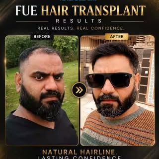 A Fuller Hairline. A Stronger Look. A Renewed Confidence. ✨

See the Before & After transformation f