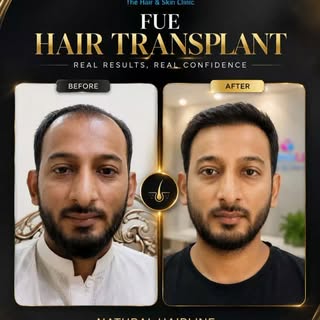 A Fuller Look. A Natural Hairline. Renewed Confidence. ✨

Every transformation tells a story. 💫
Che