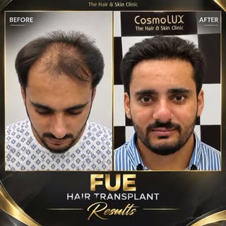 Hair restoration is about creating a natural-looking hairline, improved coverage, and a result that 