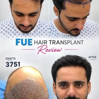 FUE Hair Transplant — Real Patient Journey

From hairline design to 3,751 grafts, this FUE Hair Tran