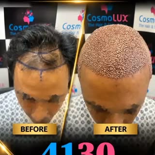 *4,130 Grafts FUE Hair Transplant Transformation | Natural Results | CosmoLUX Lahore*

Watch this am