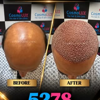 Hair restoration is about more than the number of grafts. It’s about creating a natural-looking hair