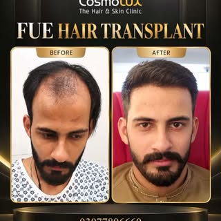 This Before & After showcases the visible transformation following an FUE Hair Transplant at CosmoLU