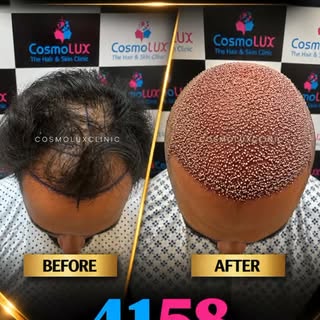 Hair restoration is about more than adding grafts — it’s about designing a natural-looking hairline,