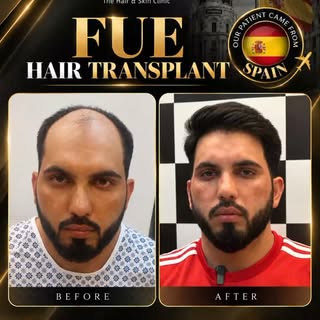 Sarfraz from Spain chose CosmoLUX Hair & Skin Clinic for his FUE Hair Transplant Surgery.

Real pati