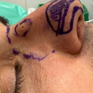 Rinosettoplastica maschile , risultato naturale secondo le desiderata del paziente 
ESTETICASANTACHI