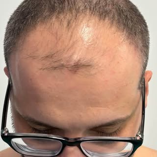 I nostri “trapianti dei capelli” a CASA DI CURA SANTA, il ragazzo venuto dalla Svizzera ed operato 7