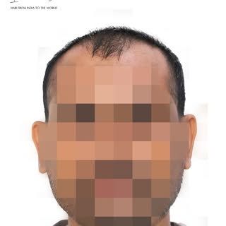 More than 5,525 grafts... this is the return of confidence. ✨
Every hair transplant tells a story—no