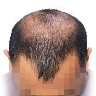 A fuller look. A stronger first impression. A confidence you can feel. ✨

With 5,525 grafts meticulo