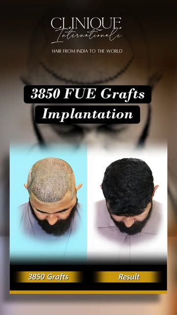 ✨ Confidence begins with the right transformation.

Witness an incredible 3850 FUE Grafts Hair Trans