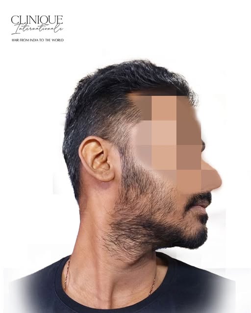 A well-defined beard isn't just about style—it's about confidence. ✨

Whether it's patchy growth, un