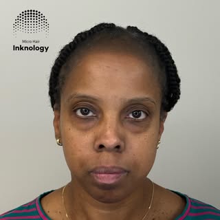 Final two months healed result with minor adjustments on the hairline for the lovely lady!😍 The hai