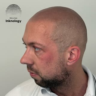 Final 2 months healed result!💣 Scalp Micropigmentation at it’s finest!⚡️

Procedure performed by pr