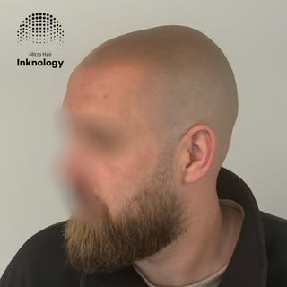 Final 2 months healed result!💣 Scalp Micropigmentation at it’s finest!⚡️

Procedure performed by pr