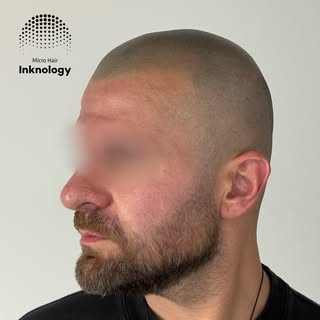 Final result fresh from the needle!💣 Scalp Micropigmentation at it’s finest!⚡️

Procedure performed