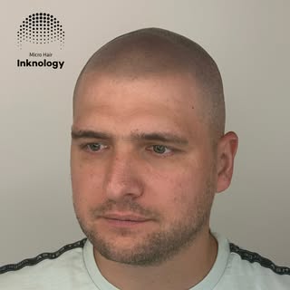 Final healed result!💣 Scalp Micropigmentation at it’s finest!⚡️

Procedure performed by pro artist: