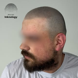 Final result fresh from the needle and last video healed!💣 Scalp Micropigmentation at it’s finest! 