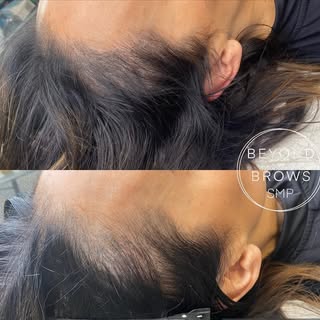 SCALP MICROPIGMENTATION 

This was a top up on my clients hairline who had work done previously else