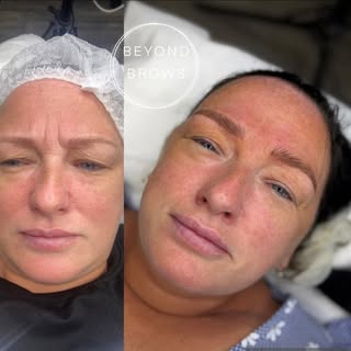 MICROBLADING 

Before any,and straight off the  blade after her 6 week top up. These will soften on 