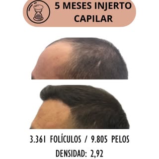 Antes y después tras 5 meses del injerto capilar de 3.361 folículos con una densidad media de 2,92 (