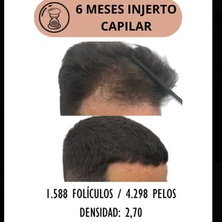 Después de 6 meses injerto capilar de 1.588 #graft obteniendo una densidad media de 2,70 (4.298 cabe