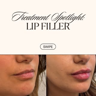💋 Plump your pout for less! 💋
For a limited time only, enjoy $100 OFF lip filler at Grover Health 