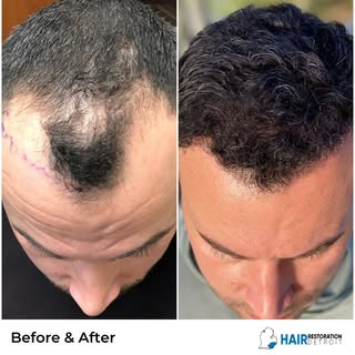 Take a peek at this before and after Neo-Graft! Contact us today to find your customized hair restor