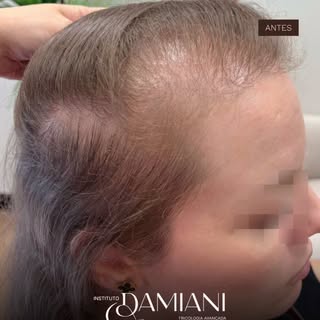 Recuperação linda desses cabelos! 🥰
Ainda em tratamento