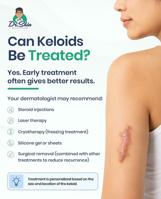 Can keloids be treated? Yes—but the right treatment depends on the keloid. 👩‍⚕️
If you have a raise