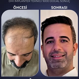 ✨ 5000 Greft, DHI İmplanter Tekniği ile %100 Doğal Sonuç! ✨

Saç ekiminde en yeni teknolojiyle, doğa