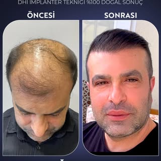 ✨ 5000 Greft, DHI İmplanter Tekniği ile %100 Doğal Sonuç! ✨

Saç ekiminde en yeni teknolojiyle, doğa