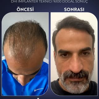 ✨ 5000 Greft, DHI İmplanter Tekniği ile %100 Doğal Sonuç! ✨

Saç ekiminde en yeni teknolojiyle, doğa