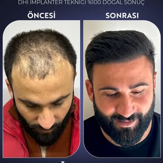 ✨ 5000 Greft, DHI İmplanter Tekniği ile %100 Doğal Sonuç! ✨

Saç ekiminde en yeni teknolojiyle, doğa