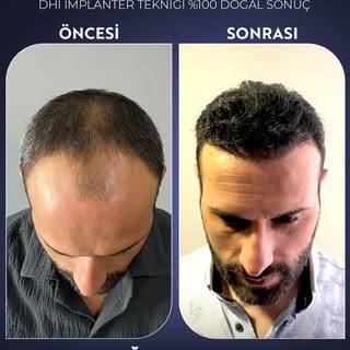 ✨ 5000 Greft, DHI İmplanter Tekniği ile %100 Doğal Sonuç! ✨

Saç ekiminde en yeni teknolojiyle, doğa