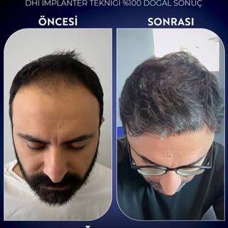 ✨ 4800 Greft, DHI İmplanter Tekniği ile %100 Doğal Sonuç! ✨

Saç ekiminde en yeni teknolojiyle, doğa