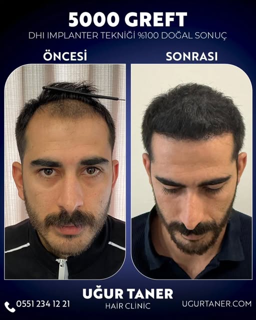 ✨ 5000 Greft, DHI İmplanter Tekniği ile %100 Doğal Sonuç! ✨

Saç ekiminde en yeni teknolojiyle, doğa
