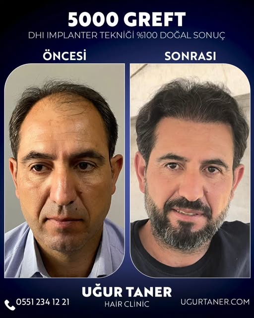 ✨ 5000 Greft, DHI İmplanter Tekniği ile %100 Doğal Sonuç! ✨

Saç ekiminde en yeni teknolojiyle, doğa