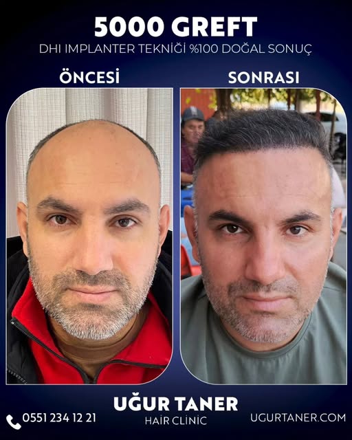 ✨ 5000 Greft, DHI İmplanter Tekniği ile %100 Doğal Sonuç! ✨

Saç ekiminde en yeni teknolojiyle, doğa
