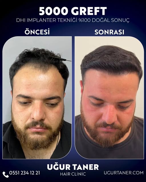 ✨ 5000 Greft, DHI İmplanter Tekniği ile %100 Doğal Sonuç! ✨

Saç ekiminde en yeni teknolojiyle, doğa