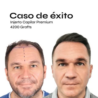 Desliza y mira como evolucionó nuestro paciente en los primeros 12 meses después de su injerto capil