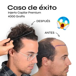 Impresionante cambio de nuestro paciente, ¿No? 😱
Nos encanta mostrar resultados porque los paciente