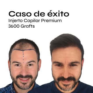 Muchas veces ni el paciente se cree el cambio que consiguen dar después de los 12 meses de su injert