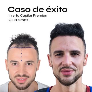 Otro ejemplo de caso de éxito, en este caso hicieron se pudieron usar 2800 grafts para conseguir est