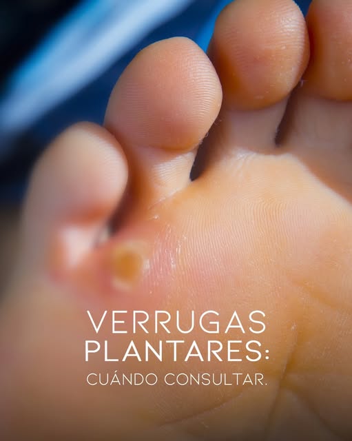 ¿Tienes una verruga plantar y no sabes si deberías consultar? 👣

Aunque algunas pueden parecer inof